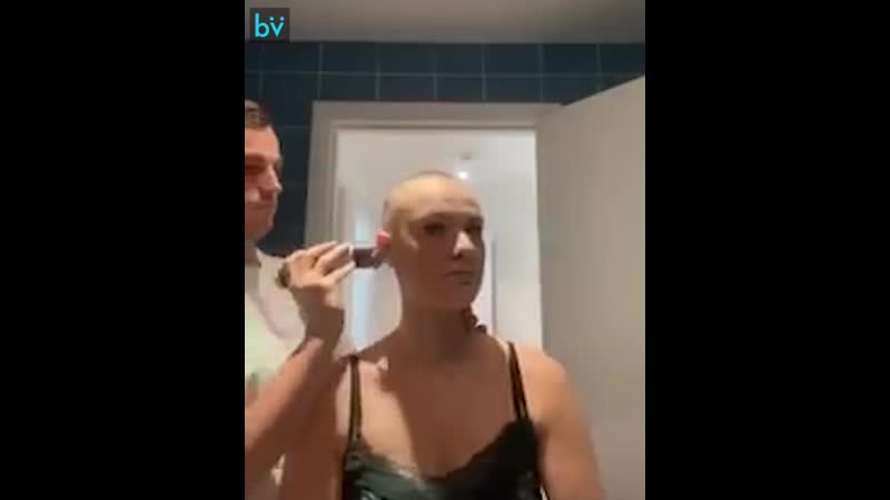 Девушка этого парня больна алопецией и он её
