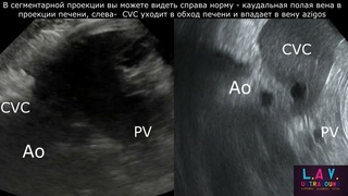 Сегментарная аплазия каудальной полой вены: УЗИ
